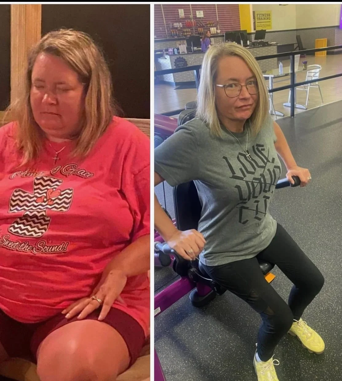 Weight Loss Surgery Before And After